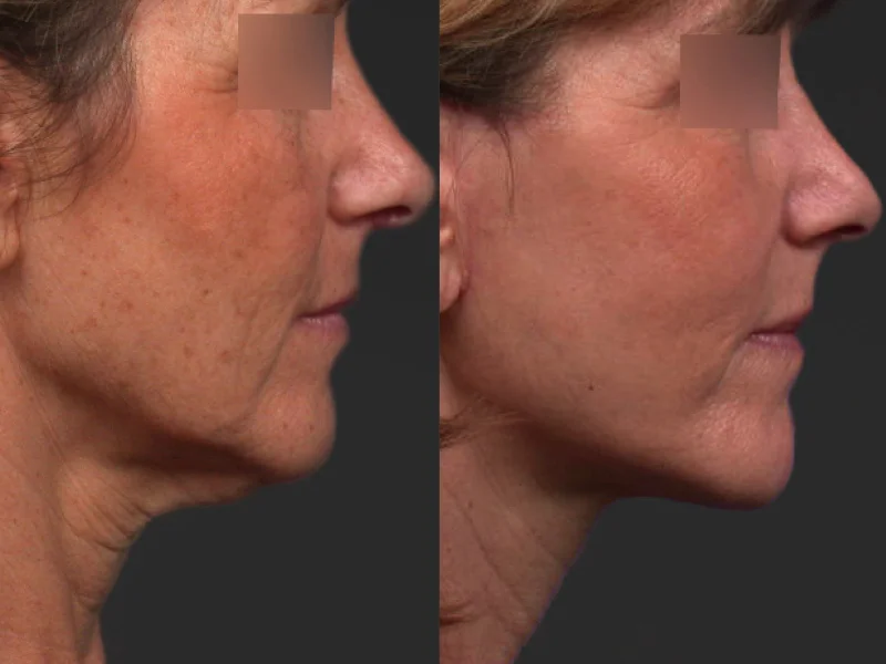 photo lift site 2 bis